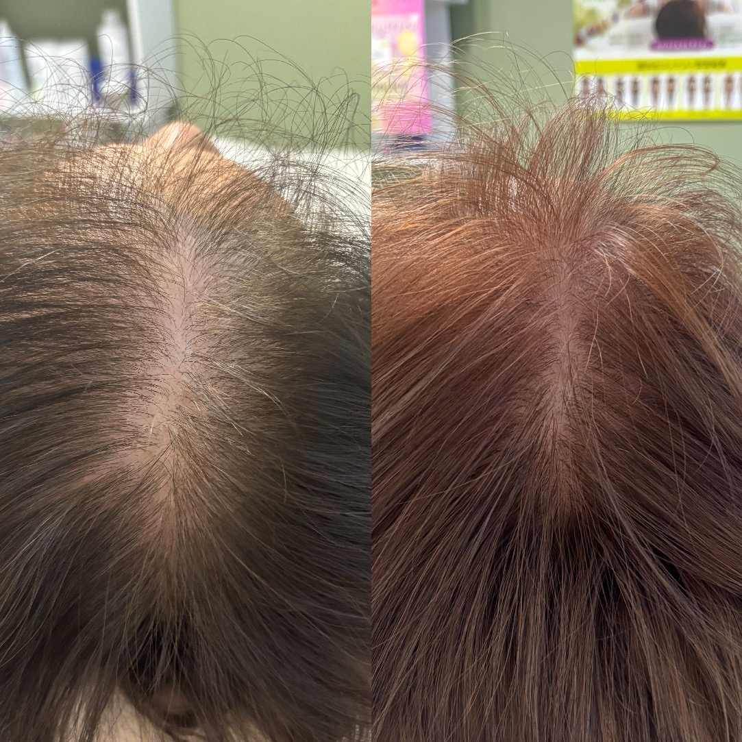 Before After 60代女性 抜け毛・地肌の透け感のお悩み
