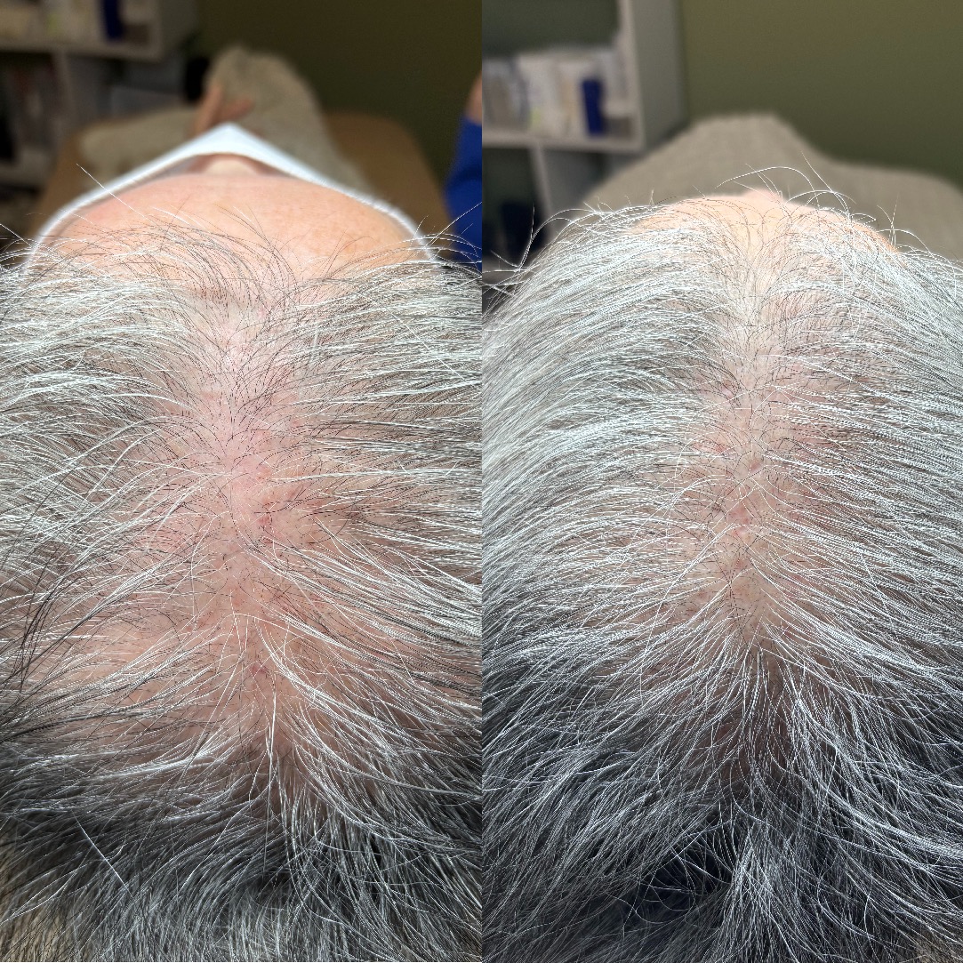Before After 60代女性 頭頂部の地肌が気になるお悩み