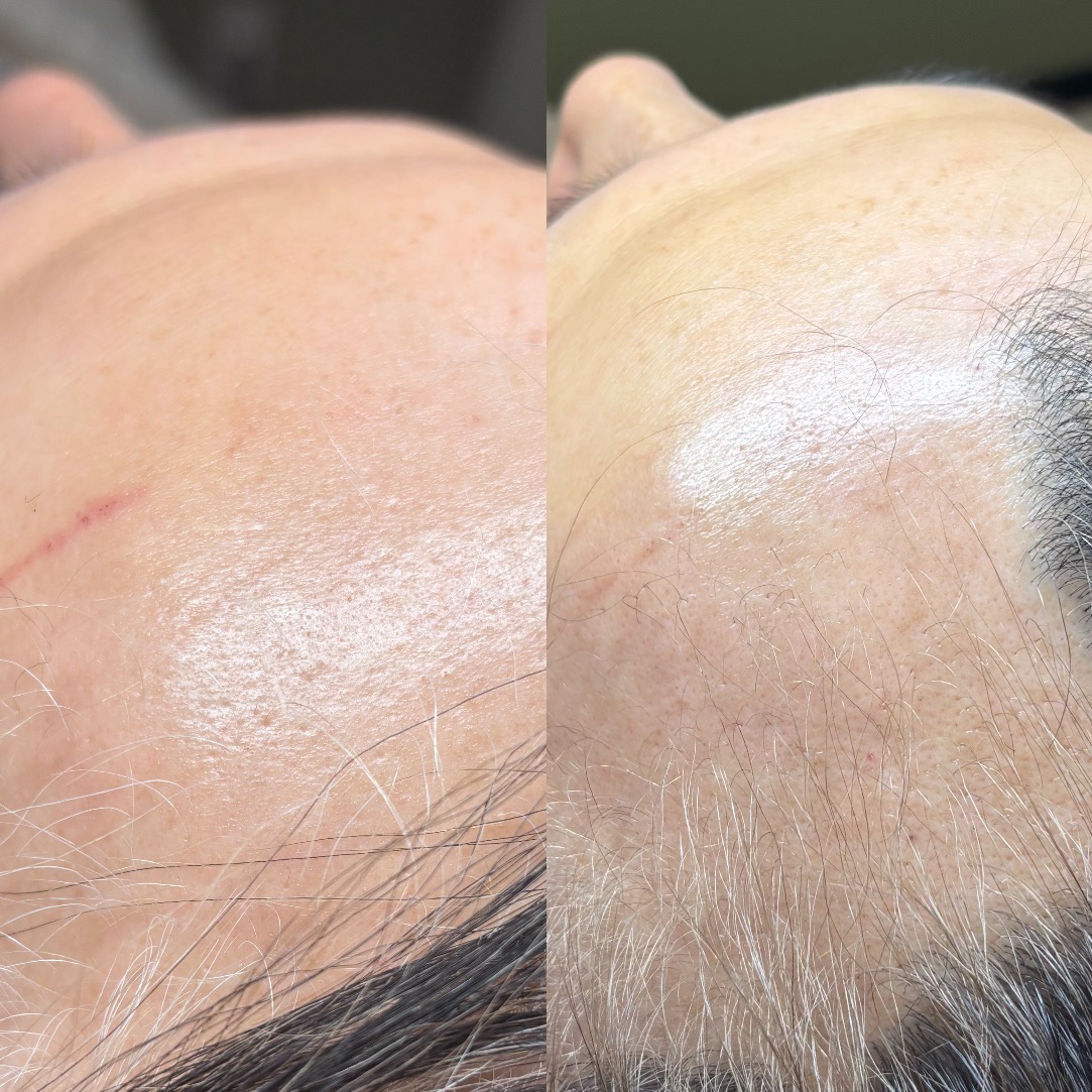 Before After 40代女性 脱毛症のお悩み